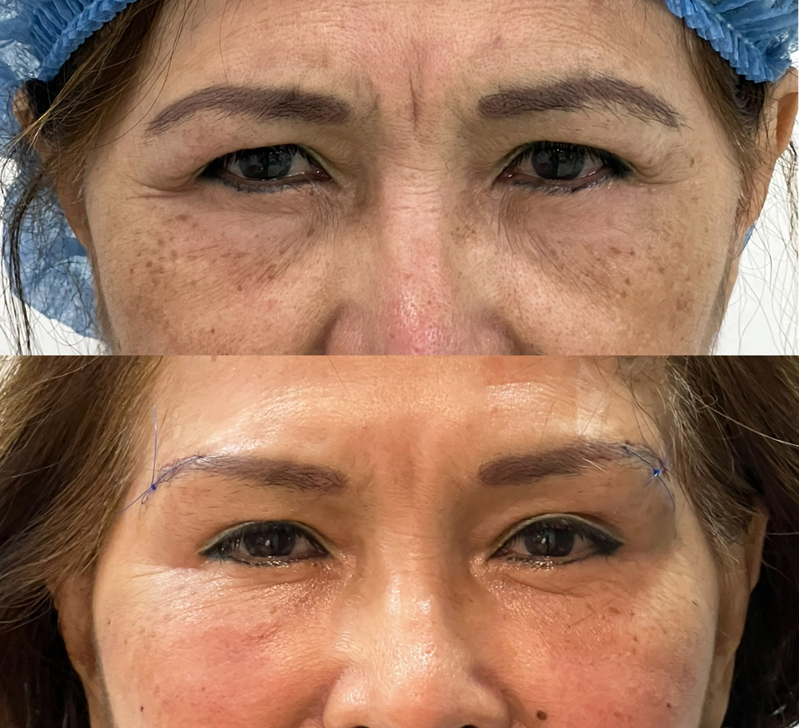 Rejuvenecimiento del rostro con grasa